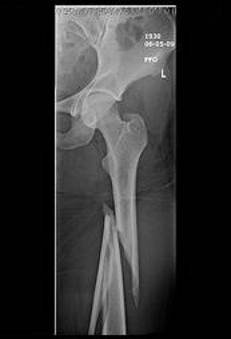 Spiral Fracture Femur Photo by jrade3138 Photobucket
