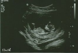 12_28_Ultrasound_edit_180